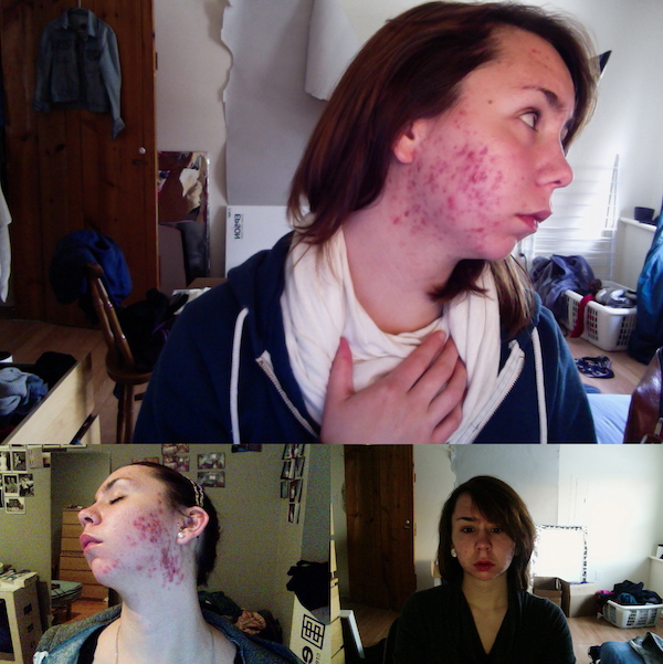 Three images of the artist taking a picture of herself to show the red welts on her face